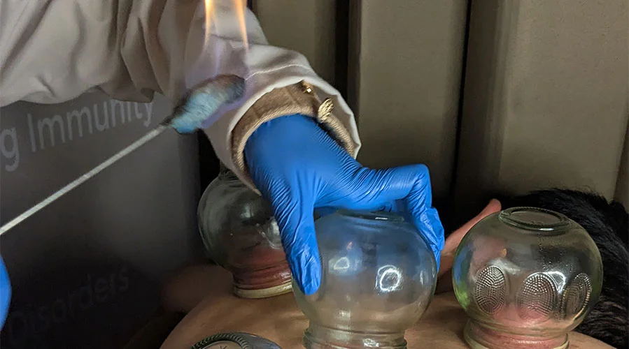 Fire Cupping 1 fire-cupping